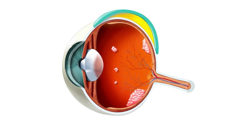 Vědci vyvíjejí hydrogelový implantát pro léčbu dětského očního nádoru